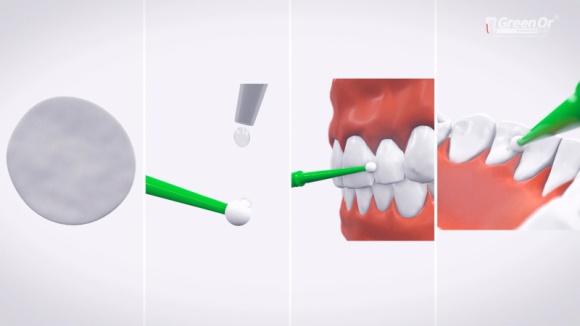 Samodzielne leczenie nadwrażliwych zębów
